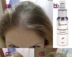 Миноксидил — революционное средство в борьбе с выпадением волос Какие виды миноксидила существуют